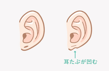 ピアス穴閉鎖