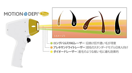 脱毛機について